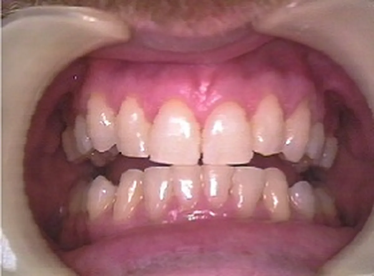 Aparat dentar fix – după