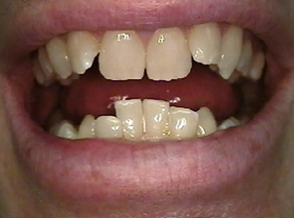 Aparat dentar fix – înainte